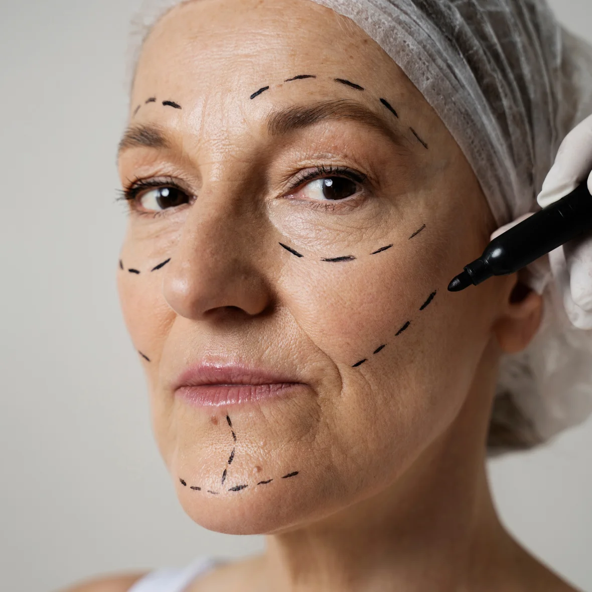 Dr Jing wang patient after cosmetic injectables anti wrinkle and dermal filler